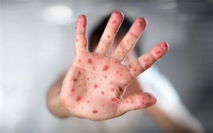 شیوع تب گوجه‌فرنگی؛ از این بیماری بیشتر بدانید