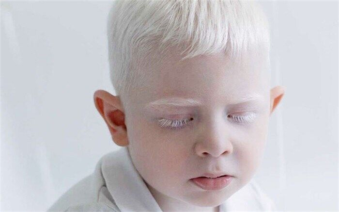 «آلبینیسم» چیست و چه علائمی دارد؟