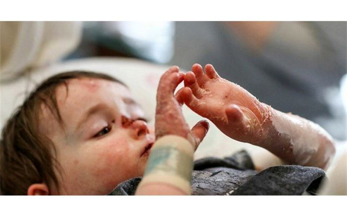 تولید پانسمان بیماران پروانه‌ای توسط جوانان اصفهانی