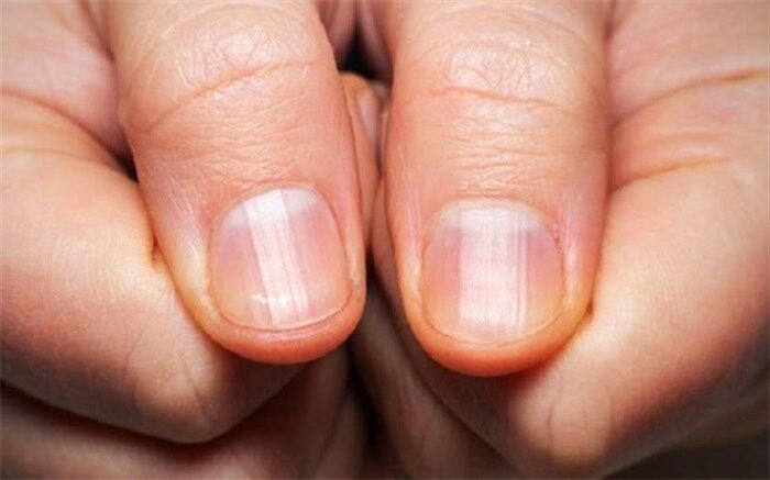 این علامت روی ناخن نشانه دیابت است
