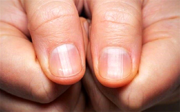 این علامت روی ناخن نشانه دیابت است