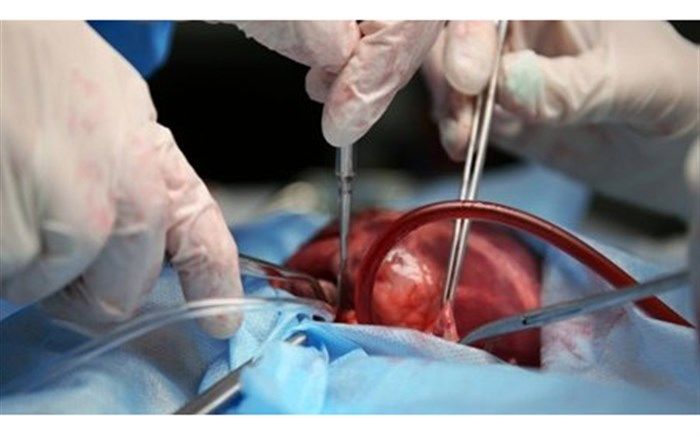 1521 مورد عمل‌ پیوند عضو در تبریز انجام گرفته است