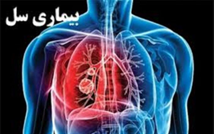 سل، یک بیماری مسری ریوی اما قابل درمان است 