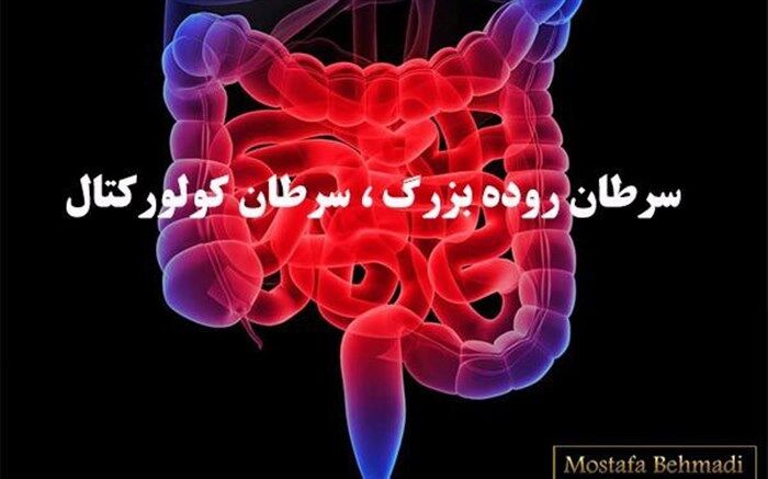 شناسایی بیش از 300 مورد مشکوک به سرطان روده بزرگ در نیشابور