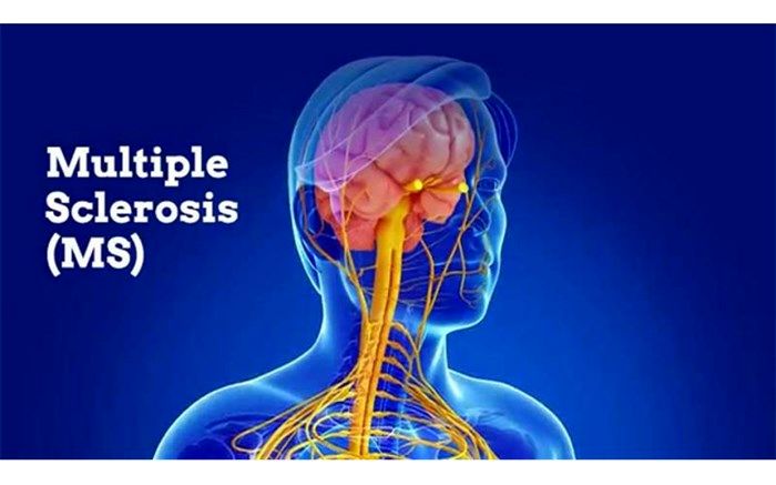 مراکز جامع ام اس خدمات بیماران ام اس را کامل ارایه می دهند