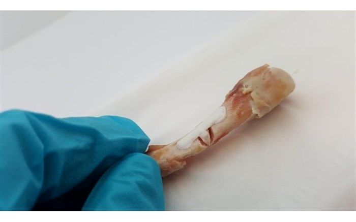 پچی که می‌تواند استخوان شکسته را ترمیم کند!