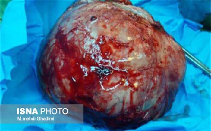 گزارش عجیبی از عمل خارج کردن غده دوکیلویی در ریه زن جوان + تصویر