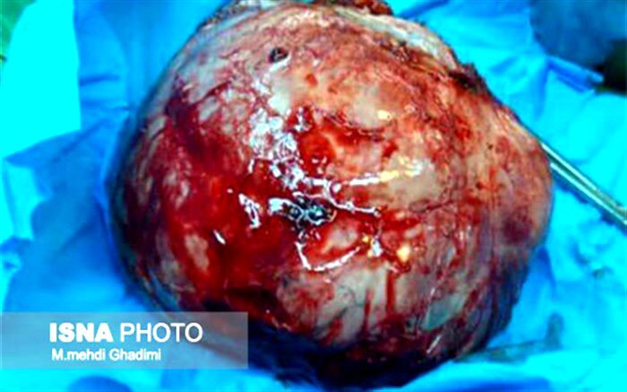 گزارش عجیبی از عمل خارج کردن غده دوکیلویی در ریه زن جوان + تصویر