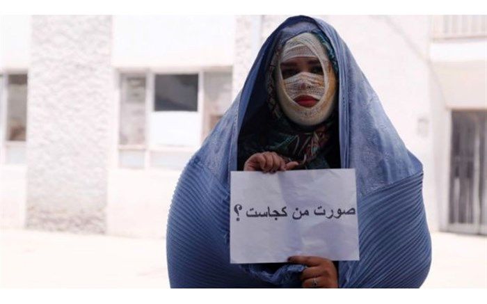 نظر ابتکار درباره طرح تشدید مجازات اسیدپاشی