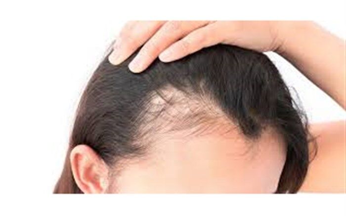 ۵ نکته برای پیشگیری از ریزش مو