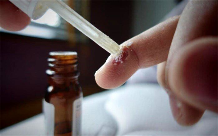 نکته بهداشتی: خلاص شدن از زگیل