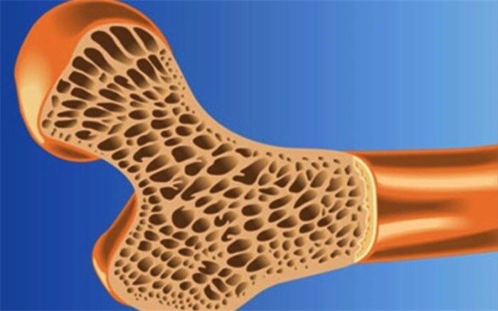 تاثیر دوز مصرفی داروی استاتین بر ریسک ابتلا به پوکی استخوان