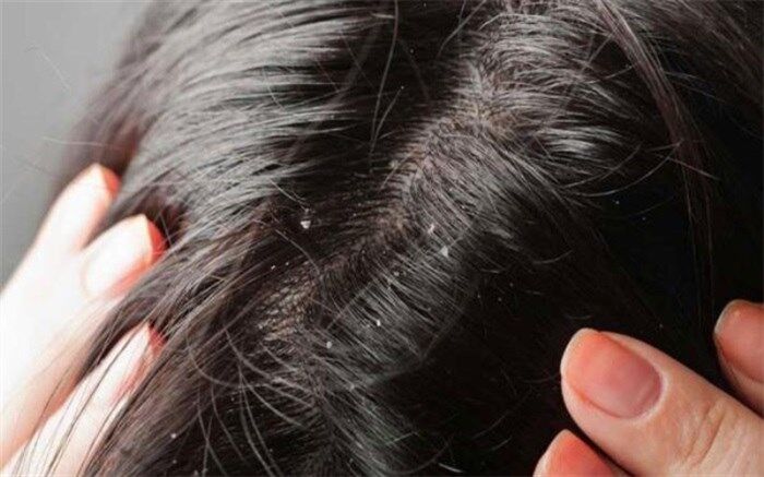 شپش نشانه وضعیت بد اجتماعی و اقتصادی نیست
