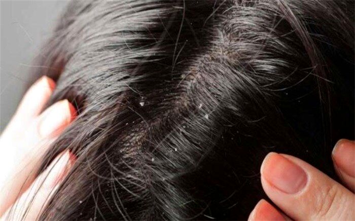شپش نشانه وضعیت بد اجتماعی و اقتصادی نیست