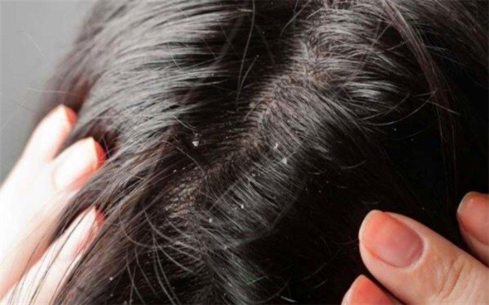 شپش نشانه وضعیت بد اجتماعی و اقتصادی نیست