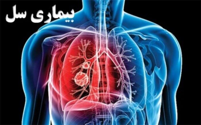 نگاهی به آمار بیماری سل در ایران+اینفوگرافی