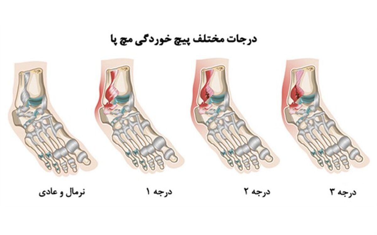 پس از پیچ خوردن مچ‌پا چه باید کرد