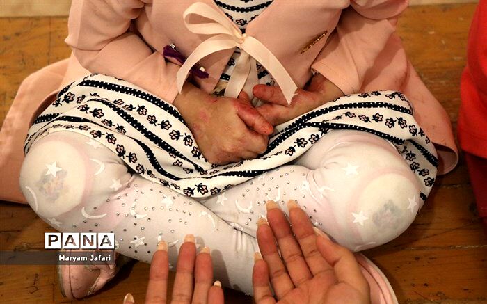 مرگ ۱۵ کودک ای‌بی به علت تحریم پانسمان میپلکس