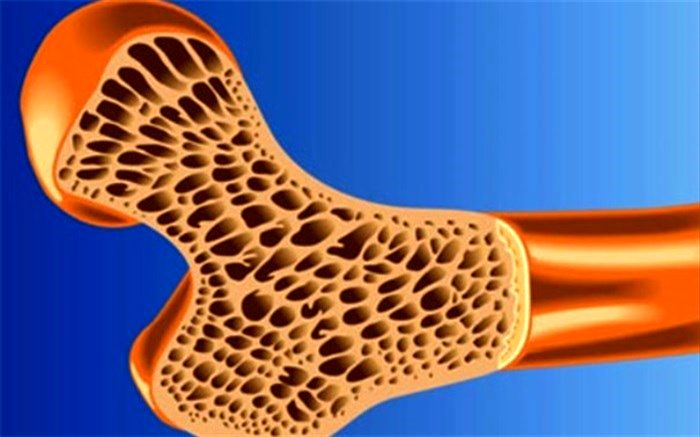 «پوکی استخوان» خود را با این ۱۵ دستورالعمل ساده درمان کنید!