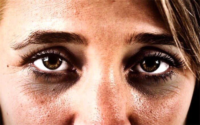 حلقه‌های تیره زیر چشم و روش‌هایی طبیعی برای بهبود آن