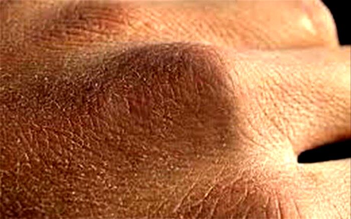 راههای مقابله با خشکی پوست دست در روزهای کرونایی