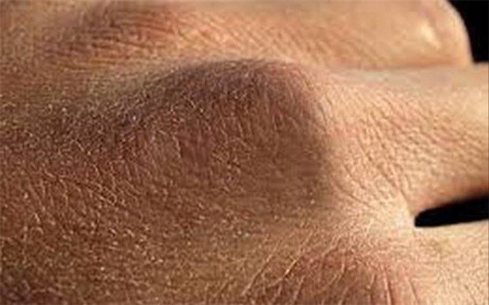 راههای مقابله با خشکی پوست دست در روزهای کرونایی
