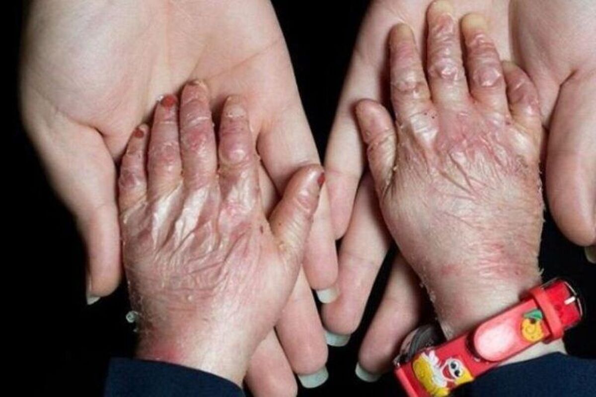 بیماران نادر؛ قربانیان وعده‌های تکراری و صندوقی که هنوز شفاف نیست