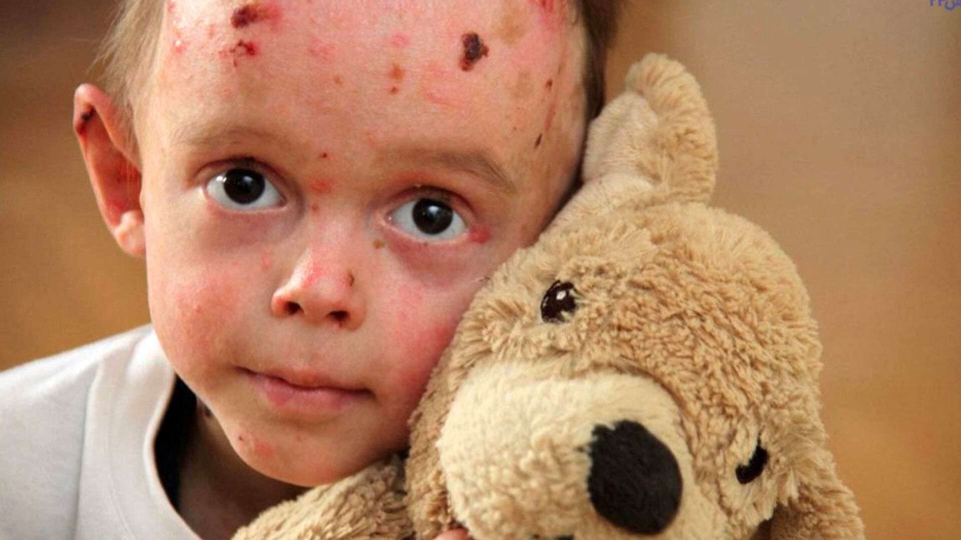 سازمان خاصی باید مسئول هزینه‌های درمانی بیماران پروانه‌ای باشد